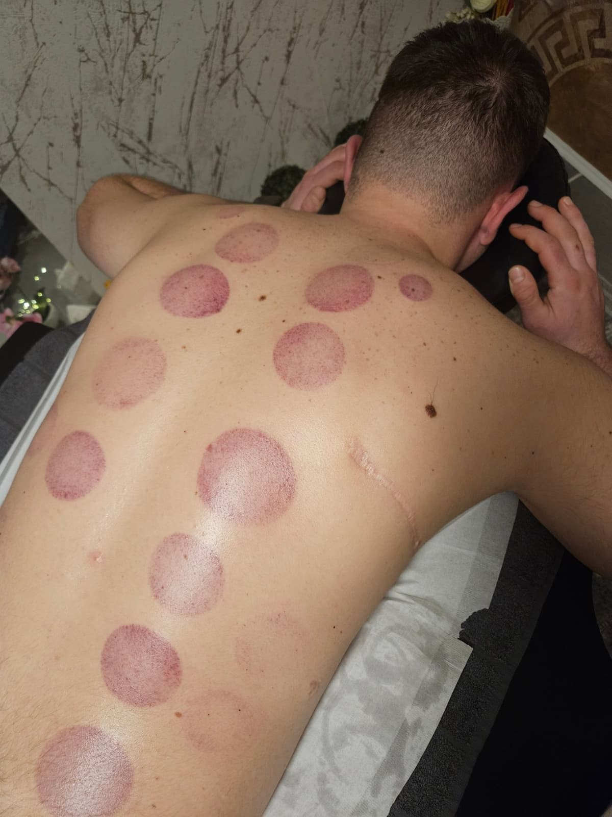 Процедура с вендузи